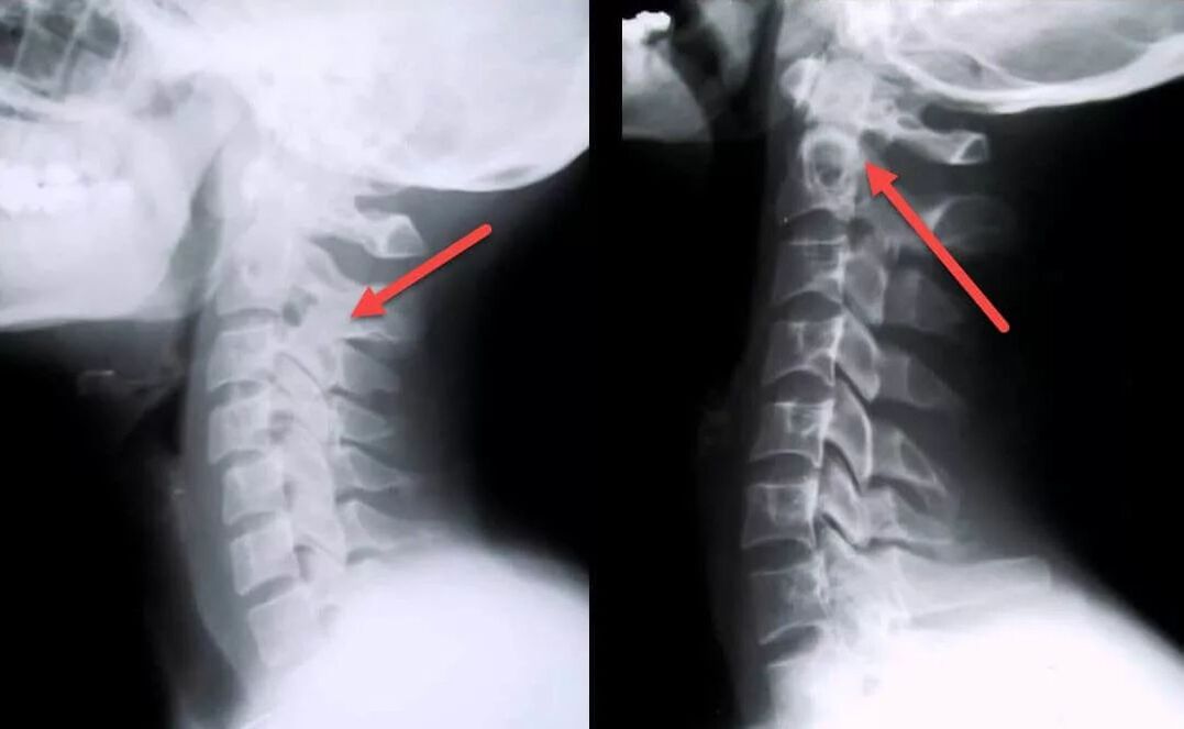 servikal osteokondroz tanısı