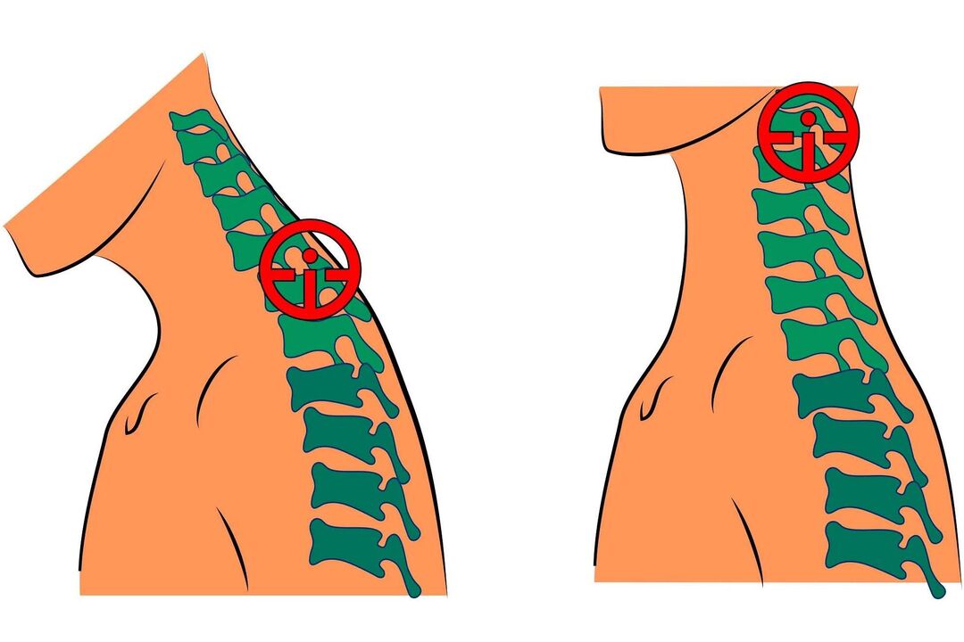 servikal osteokondroz