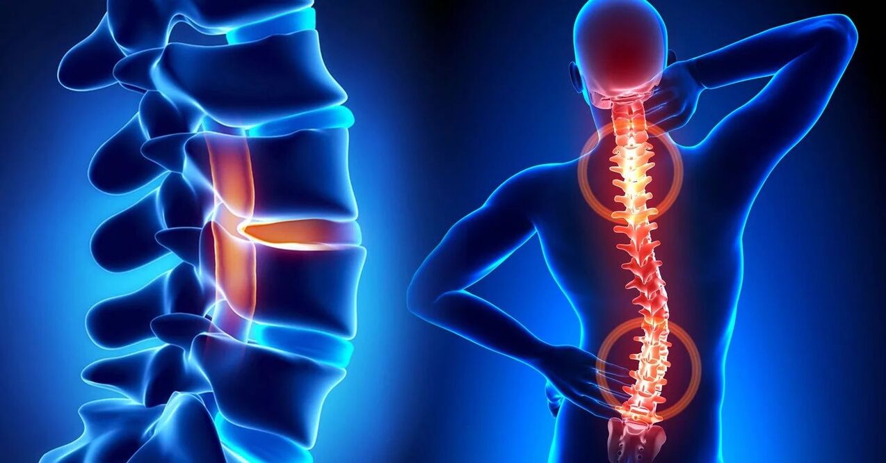 servikal osteokondrozun komplikasyonları