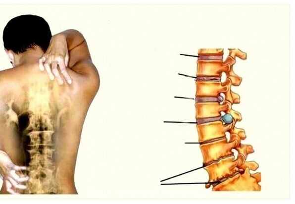 Servikal osteokondroz aşamaları