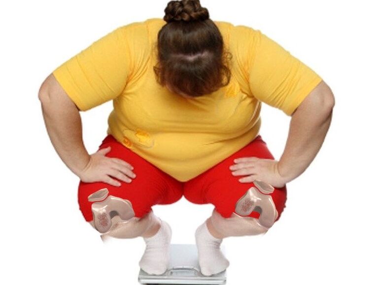 Artrozlu hastaların çoğunluğu aşırı kilolu veya obezdir